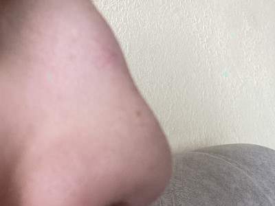 Nose surgery